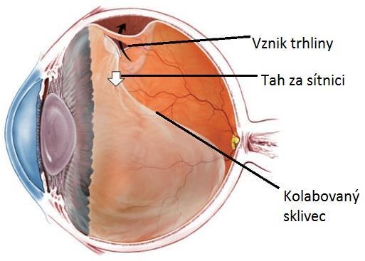 Trhliny vznikají v závislosti na přilnavosti (adhezi) a tahu sklivce. Pevné spojení sklivce a sítnice je pouze v místě ora serrata a papily zrakového nervu.