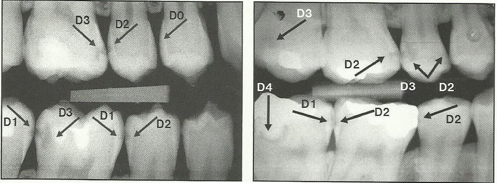 Obrázek 7 - Hodnocení nálezu na aproximálních plochách trvalých zubů Eva Kovaľová, Peter Biroš, Ivo Dřízhal, Peter Abelovský. Dentállna radiografia v praxi. 20