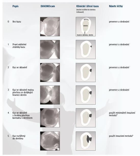 Obrázek 13 - Klasifikace nálezů DIAGNOcam http://www.kavo.cz/produkty/kavo-diagnocam-klasifikace-nalezu.pdf 3.2.6.