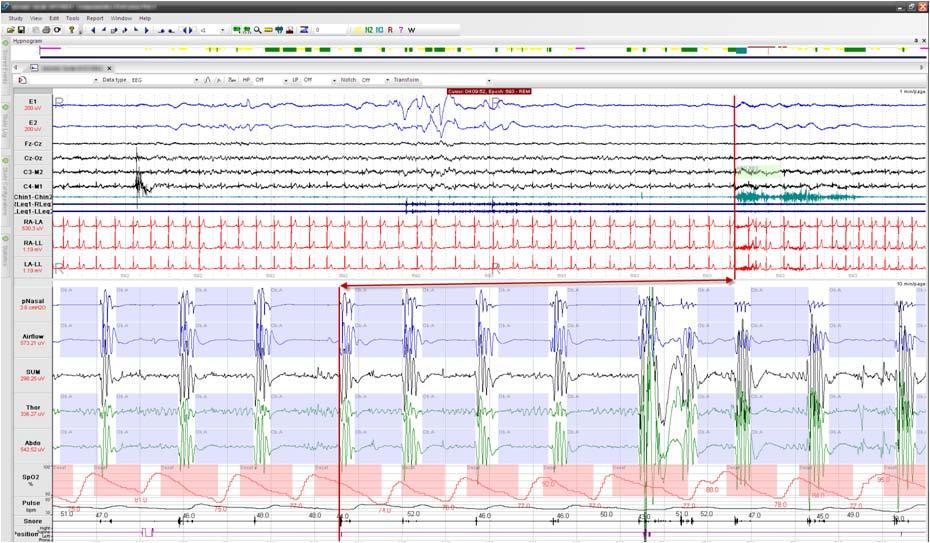 Diagnostika a léčba poruch dýchání ve spánku ve světle stanoviska ESH a novinek na sjezdu Evropské společnosti pro hypertenzi Velmi vysoký výskyt nediagnostikované OSA byl popsán u pacientů s
