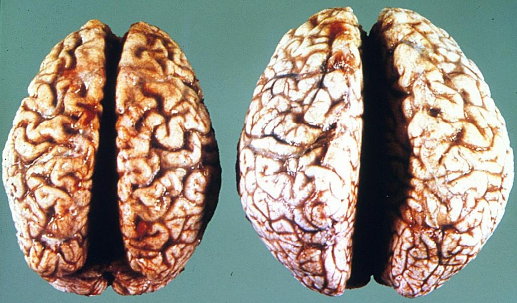 Neurosyfilis 1 2 kopie 1 atrofie, zbarvení plen a kůry