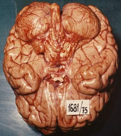 Neurinom