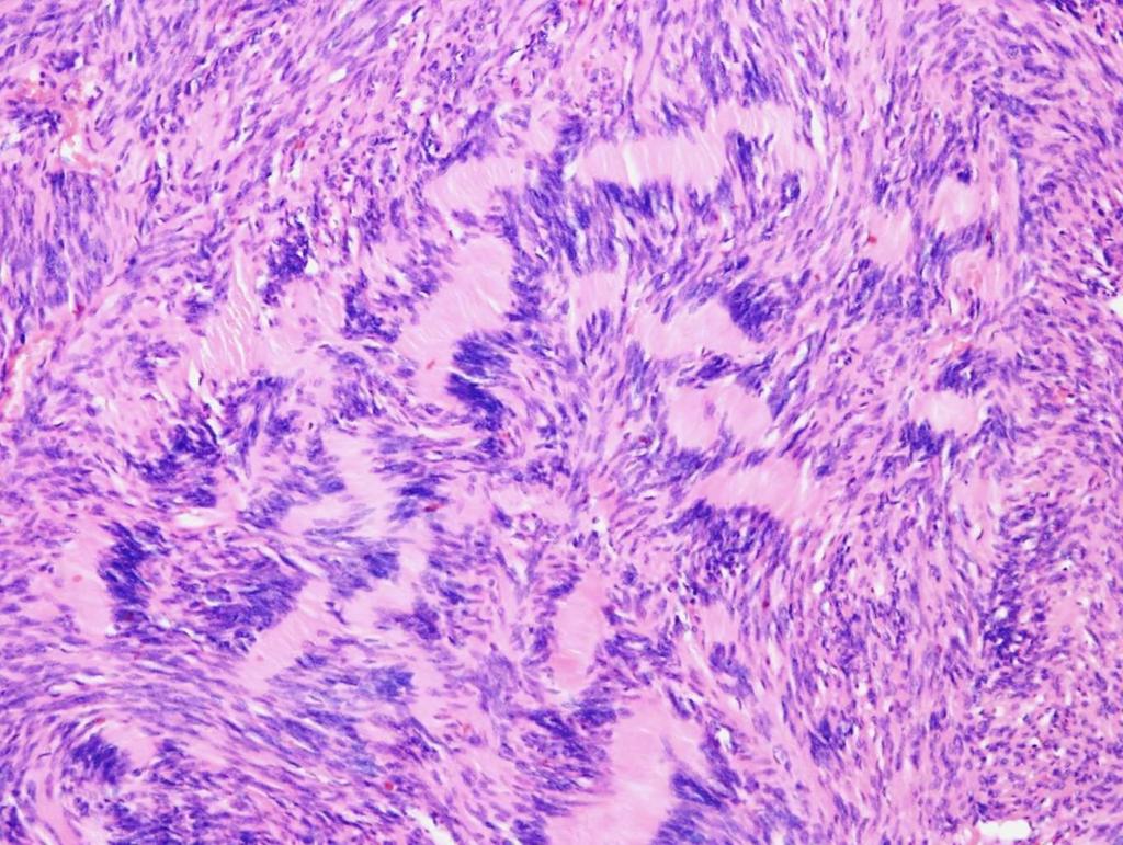 Neurinom 1 2 1