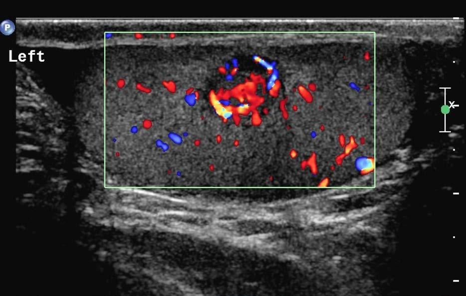 204 man who was urologically examined and treated for a suspected tumor of the testis. KEY WORDS Cryptorchism, malformation, spina bifida, splenogonadal fusion.