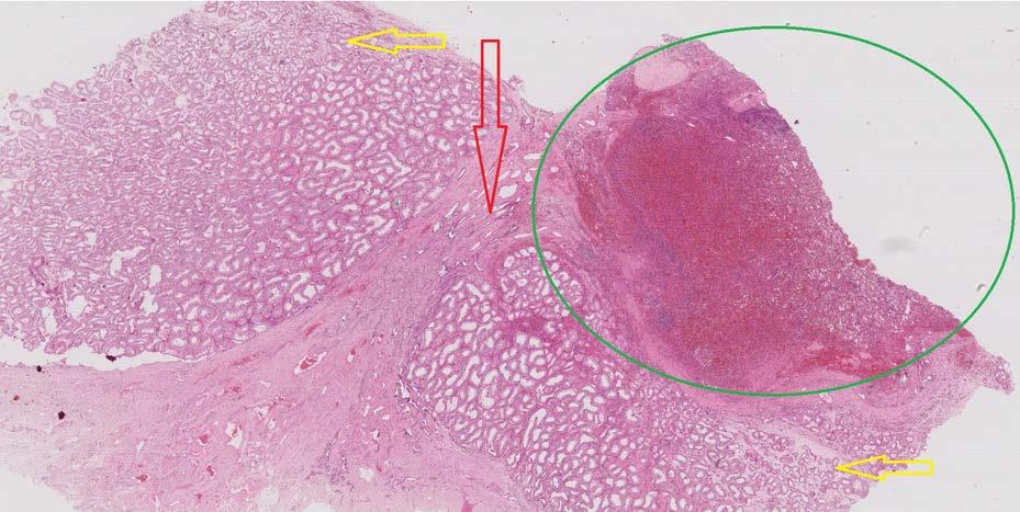 205 Vyšetření skrota barevným duplexním ultrazvukem prokázalo v oblasti rezistence levostranného varlete uzel kulovitého tvaru o velikosti kolem 1 cm, jehož struktura byla převážně hypoechogenní,