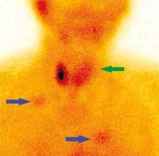 Nikde není patrné patologické ložisko zpomaleného vyplavování radiofarmaka. Fig. 1C. Planar scan 150 minutes after 99m Tc-MIBI administration. No pathologically retatined activity visible.