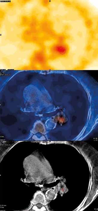 Obr. 2 Obr. 3 Obr. 2. SPECT/CT hrudníku s 99m Tc-MIBI avidním ložiskem v levém plicním hilu; nahoře SPECT řez s atenuační korekcí, uprostřed fúze SPECT a CT obrazu a dole CT obraz Fig. 2. Chest SPECT/CT.
