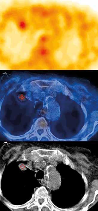 SPECT/CT hrudníku s 99m Tc-MIBI avidním ložiskem v apexu pravé plíce; nahoře SPECT řez s atenuační korekcí, uprostřed fúze SPECT a CT obrazu a dole CT obraz Fig. 3. Chest SPECT/CT.