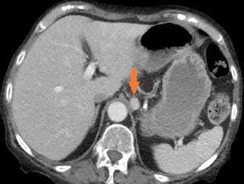 Obr. 4 Obr. 5 Obr. 4. Opacifikující se uzlina v blízkosti truncus coeliacus (červená šipka); postkontrastní CT (venózní fáze) Fig. 4. Contrast enhancement of lymph node nearby coeliac trunk (red arrow); contrast enhanced CT (venous phase) Obr.