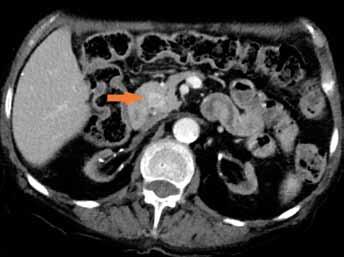Ring-like enhancement of pancreatic head lesion (red arrow); contrast enhanced CT (venous phase) Obr. 6A Obr. 6B Obr. 6A. Cysta horního pólu levé ledviny (červená šipka); nativní CT Fig. 6A. Left kidney upper pole complex cyst, red arrow; non-enhanced CT Obr.