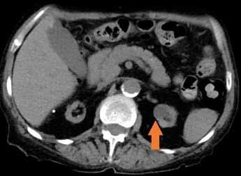 Left kidney upper pole complex cyst (Bosniak III), red arrow. Wall enhancement is clearly visible; contrast enhanced CT (venous phase) a hilová metastáza diseminovaného renálního karcinomu.