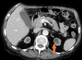nálezu. Vzhledem k pacientčiným komorbiditám a kvůli nesplnění indikačních kritérií nebyla nemocné nabídnuta biologická léčba nově diagnostikovaného renálního karcinomu.