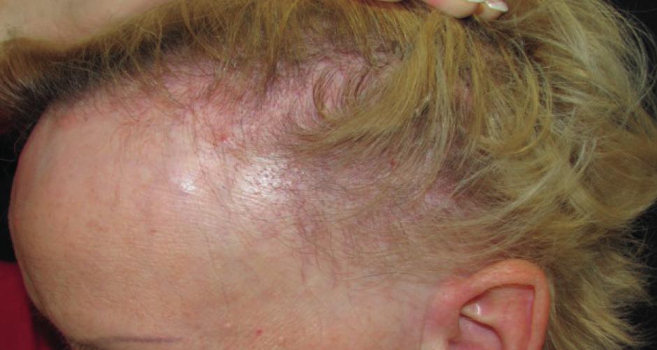 nad většími terminálními vlasovými folikuly uloženými v hloubce koria. Ve stadiu pokročilé androgenetické alopecie se nachází pozánětlivá fibróza, snížena vaskularizace kolem bulbů.
