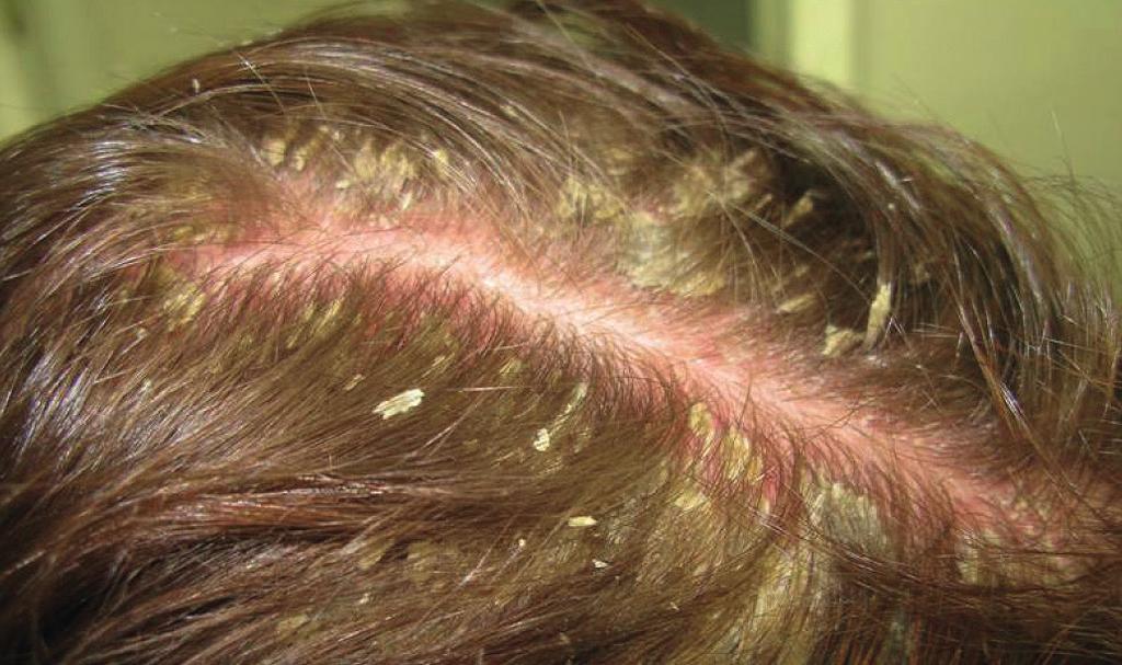 Obr. 2 nevhodná Seboroická dermatitida ve kštici; mezoterapie je Obr. 5 Třístupňová klasifikace ženské androgenetické alopecie podle Ludwiga formaci keratinu a syntézu řady hormonů.