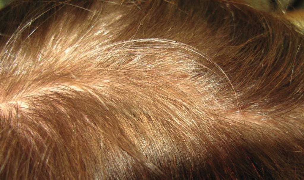 3 Pokročilá androgenetická alopecie u starší ženy, Ludwig 3 (mezoterapie neperspektivní, prognóza špatná) Vylučovací kritéria Vylučovacími kritérii jsou antikoagulační terapie, infekční a zánětlivé