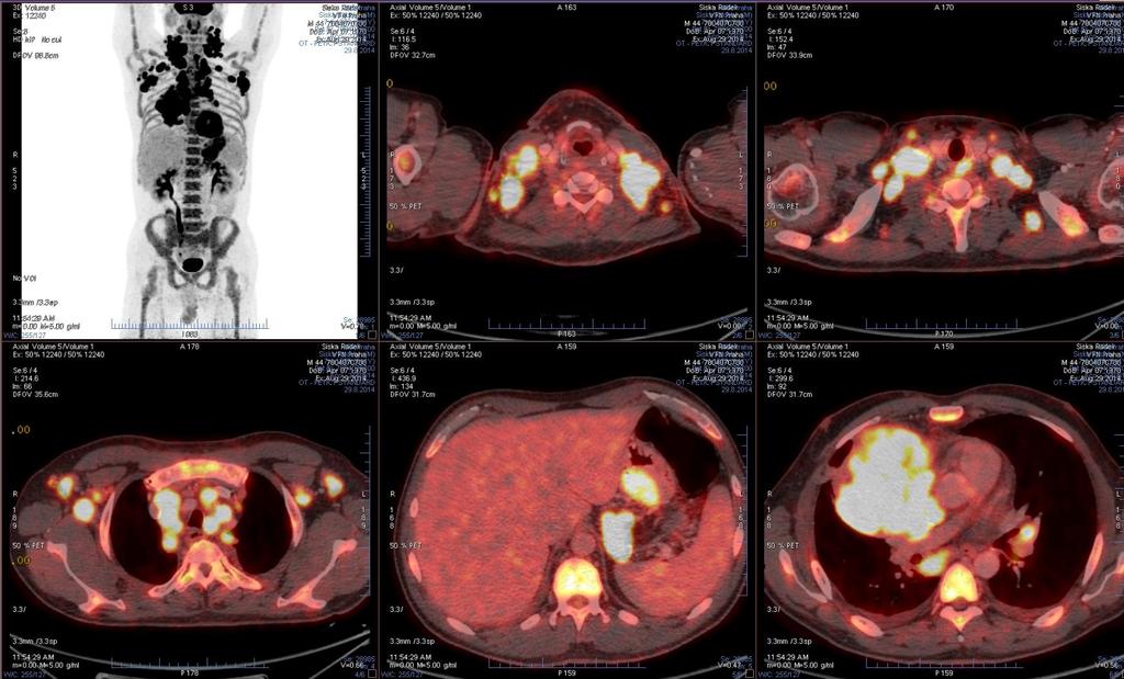 Kazuistika PET/CT