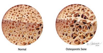 Osteoporóza Etiopatogeneza: chronicky zvýšený podíl