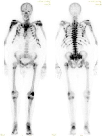 99 m-technetiumhydroxymethylene diphosphonate bone scintigraphy.