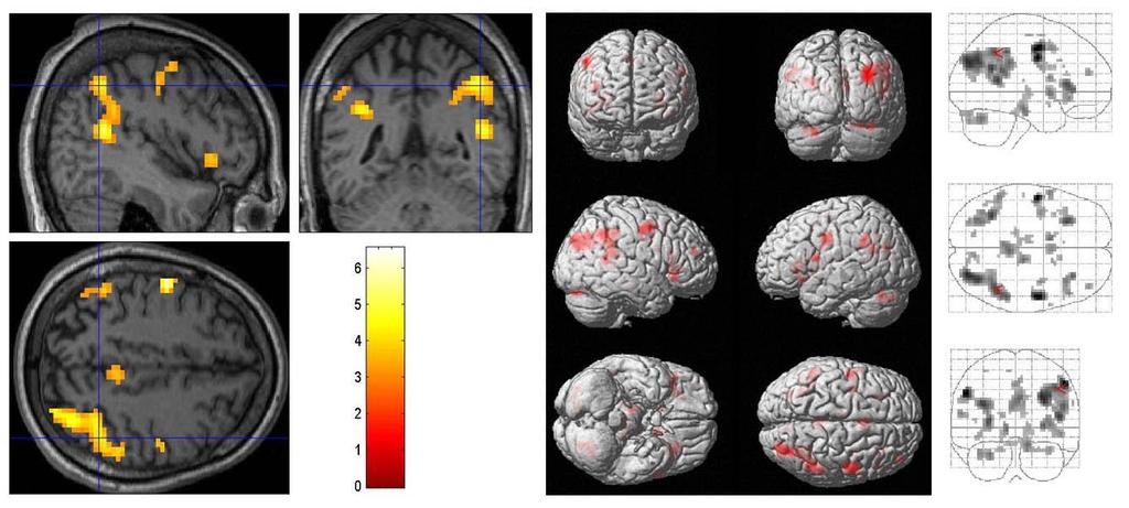 ukazují hlavní lokalizaci. Další metodou je porovnání lokalizace s anatomickým atlasem. [][] Techniku zobrazení D modelu mozku nazýváme D renderování.