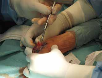 Popis implantátů Operační postup Instrumentárium Katalogová nabídka 2. Příprava lůžka pro dřík Dalším krokem je příprava lůžka pro dřík TEP.