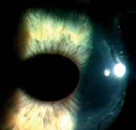 Ke korekci jsou uţívány silikonhydrogelové nebo gelové kontaktní čočky. Obr. 24: Uvolněný štěp po LASIK úspěšně léčený terapeutickou kontaktní čočkou 4.2.4.1.8.