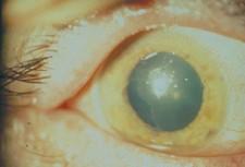 U recidivující eroze rohovky můţe být výborných výsledků dosaţeno pomocí dlouhodobé aplikace terapeutické kontaktní čočky.