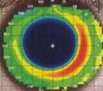 29: Topografické snímky rohovky před první aplikací(a), po několika dnech nošení ortokeratologické kontaktní čočky(b) a diference obou předchozích snímků(c). Obr.