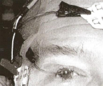 4.2.7.2. Elektroretinografie Elektroretinografie (ERG) je vyšetřovací metoda, která zaznamenává elektrické potenciály vznikající v sítnici po jejím osvitu.