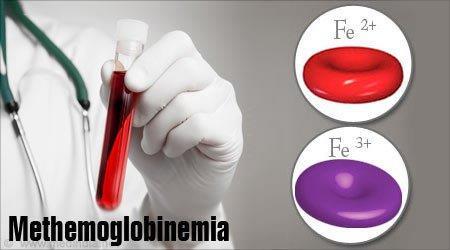 Methemoglobinémie Oxidace Fe 2+ na Fe 3+, které není schopno vázat O 2 -