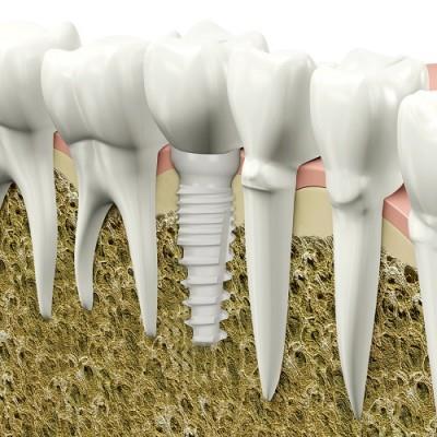 4.1.2 Dentální aplikace V dnešní době se keramické biomateriály používané v dentálních aplikacích stávají stále zajímavějšími.