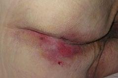 Gentského Globální nástroj pro hodnocení IAD Kategorie 1: Přetrvávající zarudnutí 1A - Trvalé zarudnutí bez klinických známek infekce Trvalé zarudnu Různé tóny zarudnutí.