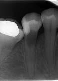 úraz do 9 let věku, je mnohonásobně pravděpodobnější, že se úraz bude opakovat (angl. multiple dental trauma episodes, MDTE) (13).