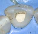 pre-eruptive intracoronal resorption; PEIR): je resorptivní léze, jež je lokalizována v dentinu blízko dentinosklovinné hranice, nejčastěji pod okluzní ploškou klinické korunky (obr. 12).