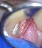 LKS 11/2018 ODBORNÉ SDĚLENÍ 253 Obr. 20: Chirurgická terapie ECIR gingivoplastika. 1. diagnostický rentgenový snímek; 2. stav po provedení gingivoplastiky, zavedení a utěsnění matrice; 3.