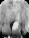 internal approach): odpovídá endodontickému ošetření a odstranění resorptivní tkáně přes trepanační otvor.