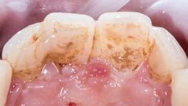 Resorptivní léze ale musí být přístupná bez nadměrného odstranění pericervikálního dentinu (43). Velmi důležité je odstranit resorptivní tkáň kompletně až po předpokládané místo vstupu.