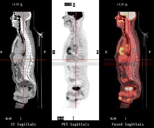 2 Hybridní zobrazovací systémy Obrázek 15: Fúzovaný řez PET/CT [5] 2.5.2 PET/MR PET/MR, kombinace magnetické rezonance a pozitronové emisní tomografie, je nejnovější zobrazovací metoda.