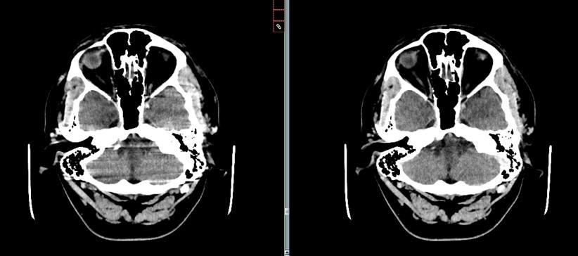 3 Obrazové artefakty výpočetní tomografie 3 Obrazové artefakty Obrazové artefakty představují uměle vytvořené rušivé struktury ve výsledném obrazu.