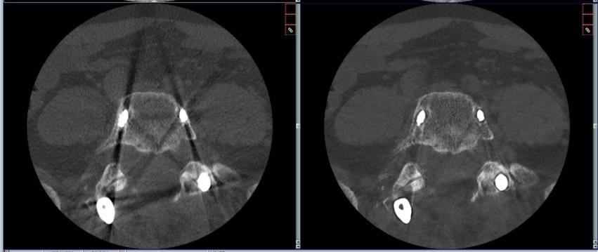 3 Obrazové artefakty výpočetní tomografie 3.1.2 Artefakt vlivem kovových částí Umístění kovového materiálu v zorném poli vede k nadměrné absorpci rentgenového záření cizím kovovým objektem.