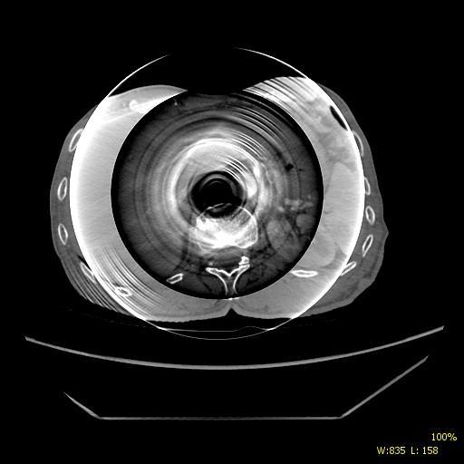 3 Obrazové artefakty výpočetní tomografie pokud objem voxelu obsahuje informaci o více rozdílných tkáních, které mají různý koeficient zeslabení.