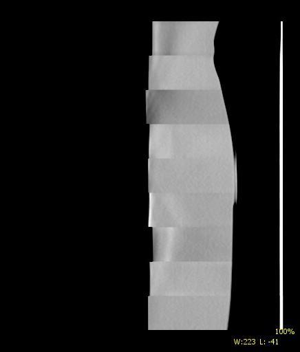3 Obrazové artefakty výpočetní tomografie Při spirálním vyšetření lze navíc pozorovat tzv. stupňovitý artefakt (stair-step artefakt).