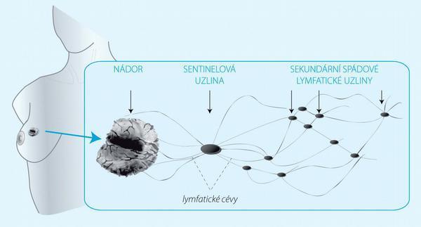 tumoru k uzlinám nacházejících se ve vyšší etáži, či pozánětlivé změny v lymfatickém povodí a uzlinách způsobené tuberkulózou nebo jinou fibrózou.