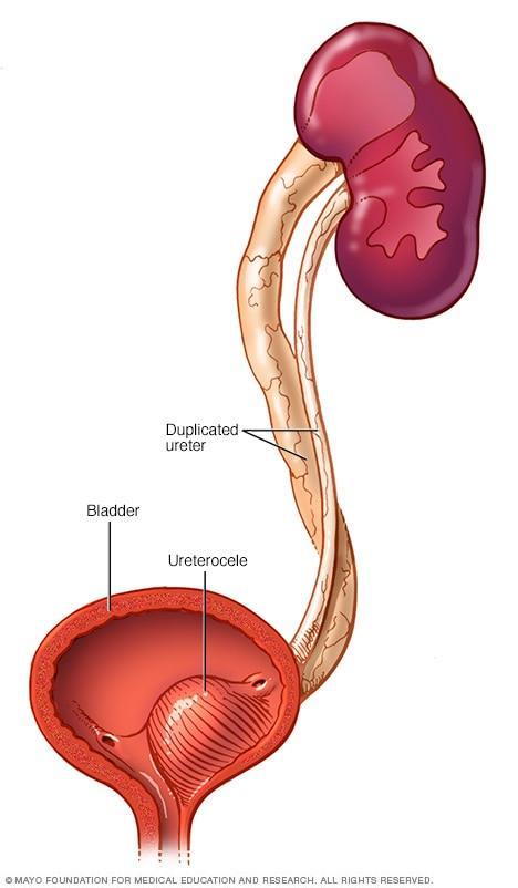 Zdvojený dutý systém ledviny, ureterokéla ektopické ústí ureterokéla
