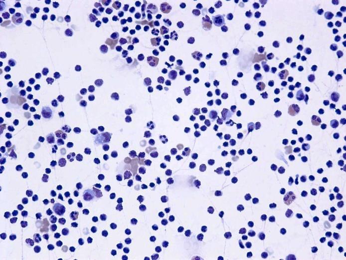 vyznačuje hojnou produkcí prozánětlivých cytokinů interleukinu 1 (IL-1) a tumornekrotizujícího faktoru α (TNF-α). Obr. 11: Převaha lymfocytárních buněk v hrudním výpotku 6.1.2 Monocytárně-makrofagické elementy Monocytárně-makrofagické elementy (Obr.