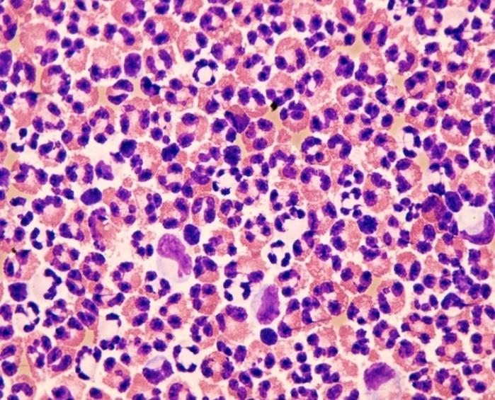 Eosinofilní granulocyty jsou téţ významným producentem transformujícího růstového faktoru β (TGF-β), nezbytného pro průběh reparačních procesů.