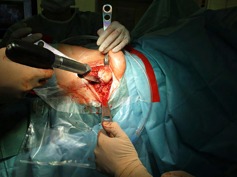 Obr. 3 Osteotomie krčku femuru. Pokud chce operatér dosáhnout patřičné prolongace postižené končetiny, má tyto možnosti: 1. Vysoko vedená osteotomie v oblasti krčku femuru 2.
