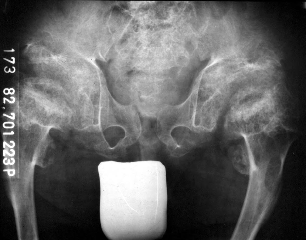 Fig. 2 A. X-rays, at age 12 years. Hypoplasia of the bodies of the iliac bones. Inferiorly directed lesser trochanters.