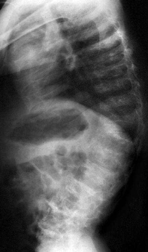 Fig. 2 B C. X-rays, at age 12 years. (B) kyphoscoliosis, severe platyspondyly, posterior lumbar body concavity.