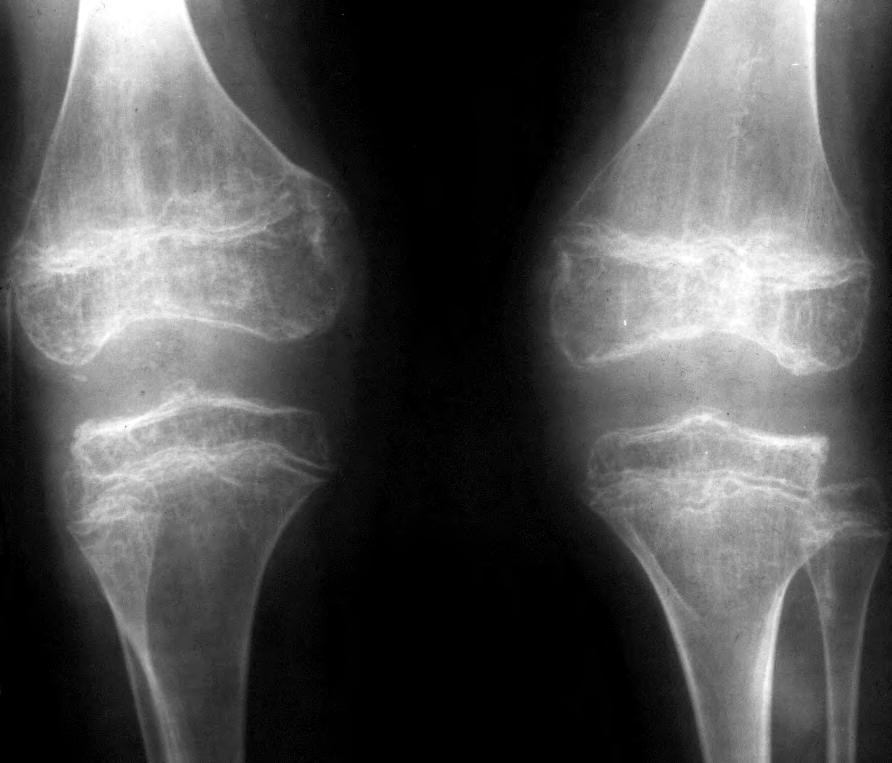 Fig. 2 D. Flattening of intercondylar femoral notch and epiphyses, long bone shortening with marked metaphyseal flaring.