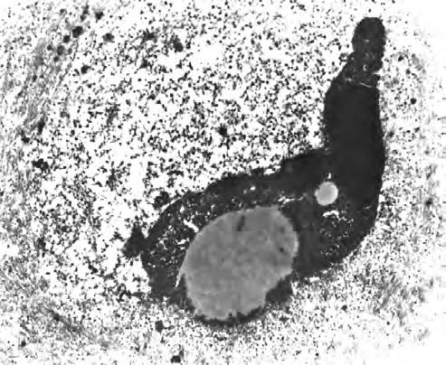A B C Fig 3 A C. Electron microscopic findings.